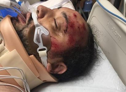 Black man lying in hospital bed with red blotches all over his face with a breathing machine and neck brace